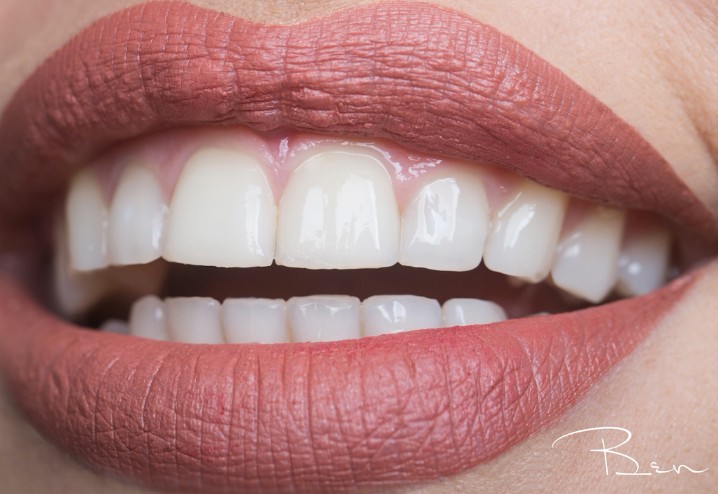 美白牙齿,分享四种美白牙齿的方法_化妆美容